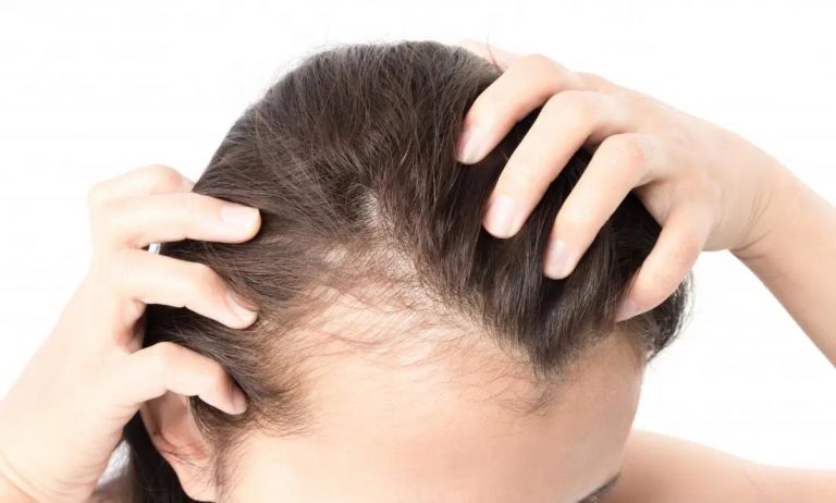 chute de cheveux cause, diagnostique et traitements, bilan chute de cheveux au laboratoire d'analyses à Chlef en Algérie
